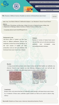 Reaction of different fractions of hydatid cyst antisera with human breast cancer tissues