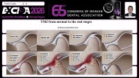 TMJ from normal to the end stages